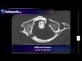 Jefferson fracture - radiology video tutorial (x-ray, CT)
