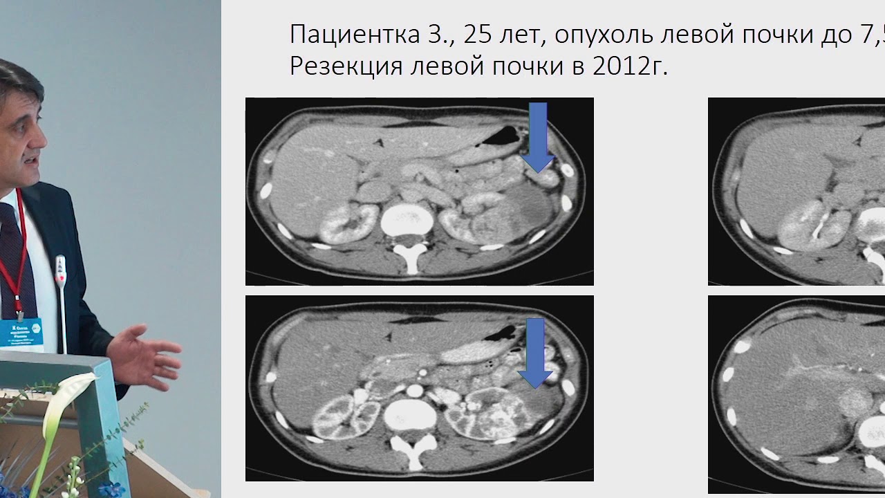 Рецидив почки