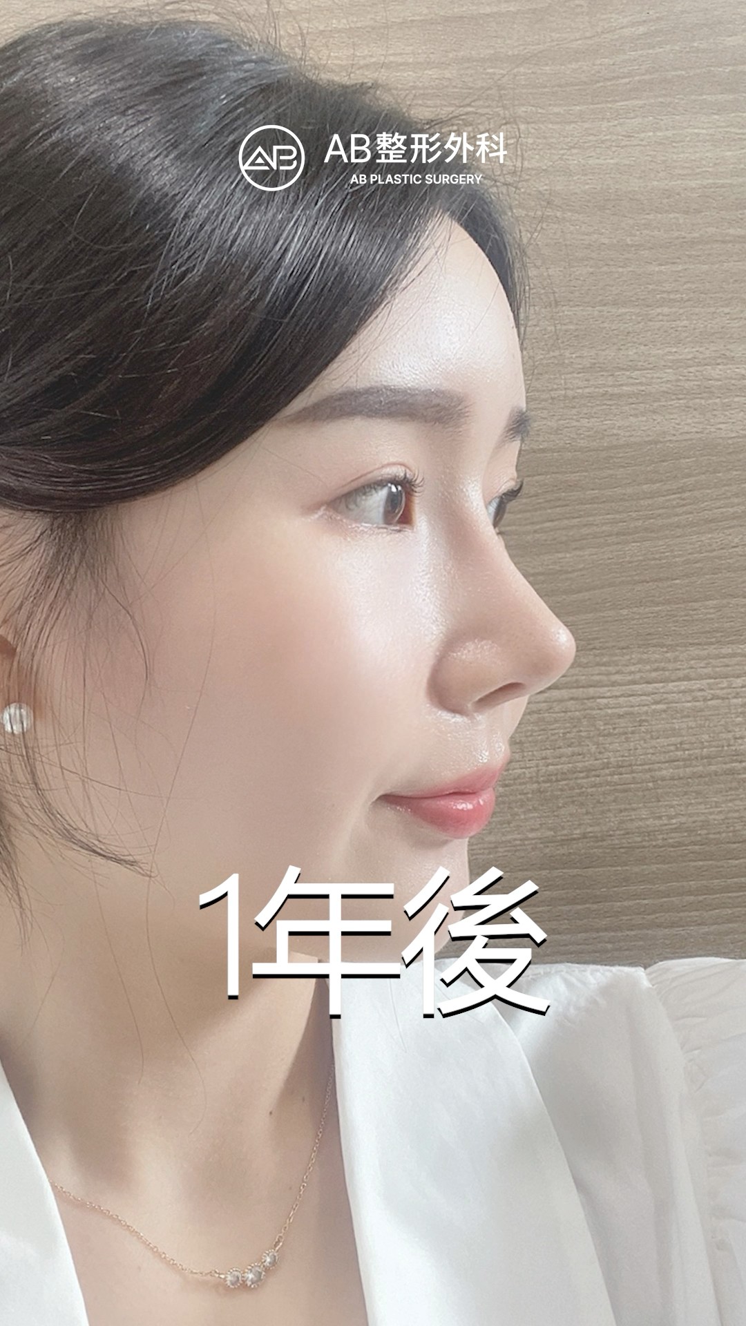削骨＋隆鼻滿一年，自然又精緻的改變！ #shorts