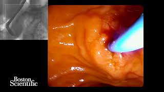 Management of pancreatic duct stricture in chronic pancreatitis using Exalt single-use duodenoscope