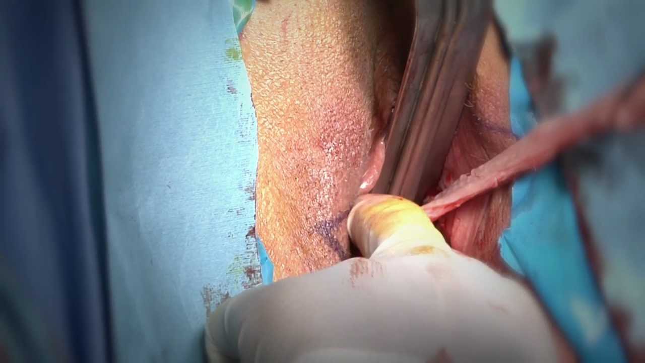 Vaginoplasty surgery surgery by Dr Laith Barnouti. 