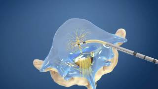 Intracept® Procedure for Chronic Low Back Pain | Innovative Pain and Spine Institute