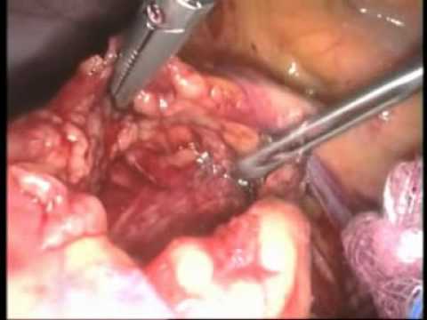 laparoscopic low anterior resection 1