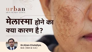 मेलास्मा होने का क्या कारण है? | What Causes Melasma On The Face | Dr Kiran Chotaliya, Pune