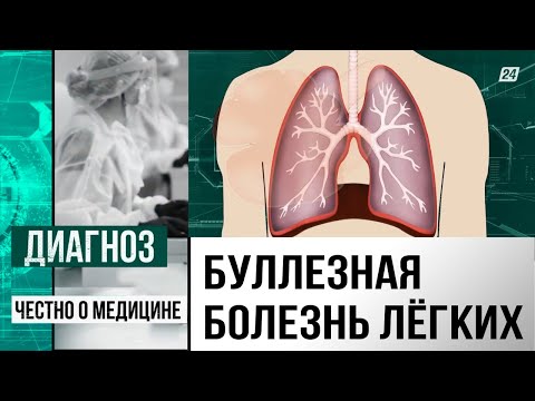 Что такое буллезная эмфизема лёгких и как не умереть от обычного кашля? | Диагноз