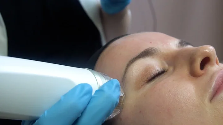 How RF Microneedling Tightens Skin #microneedling #endymed #rf