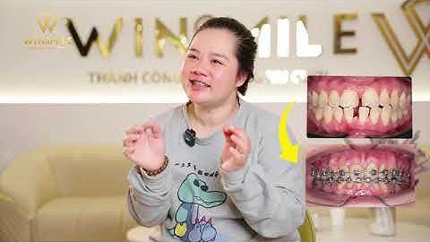 Răng thưa nên niềng răng hay bọc răng sứ? Khách hàng của Win Smile chọn gì?| Nha khoa Win Smile