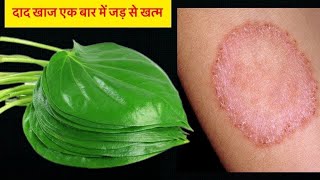 दाद खाज खुजली की 2 दिन में छुट्टी कर देगा Fungal Infection Treatment at Home / Daad Khaj Khujli
