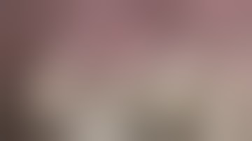 Lateral Window Sinus Graft Case with EthOss®