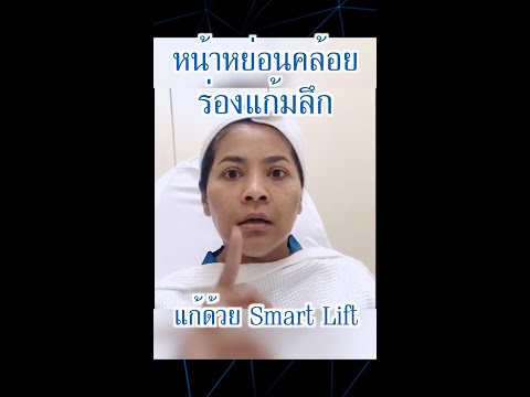 คุณตั๊ก ศิริพร‼ หลังทำ Smart Lift “หน้ายกกระชับขึ้นทันที ไม่เจ็บ สุดยอดมากค่ะ”
