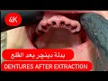 MAKING FULL UPPER AND LOWER SIRGICAL DENTURES(difficult case) 4K طريقة صنع دينچر فوري جراحي #waxbae