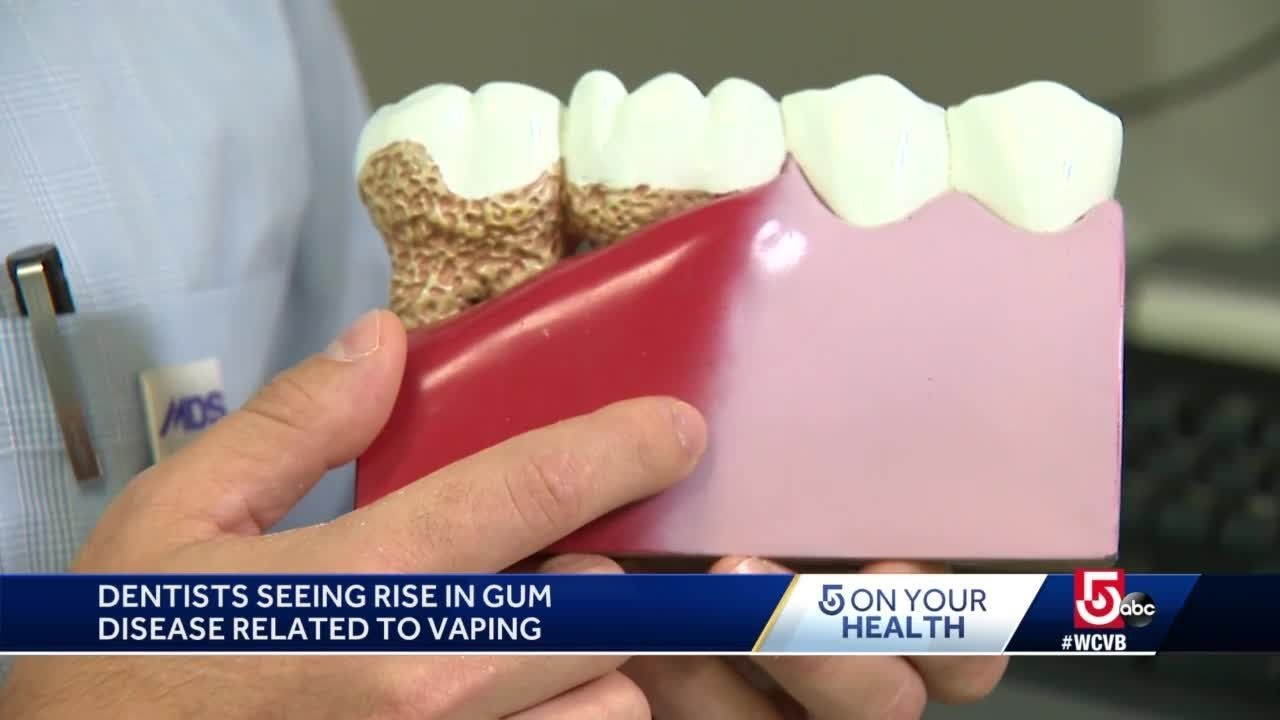 Local Dentist Explains Why Vaping Is Dangerous For Teeth