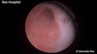 Hysteroscopic correction of Ashermans syndrome 