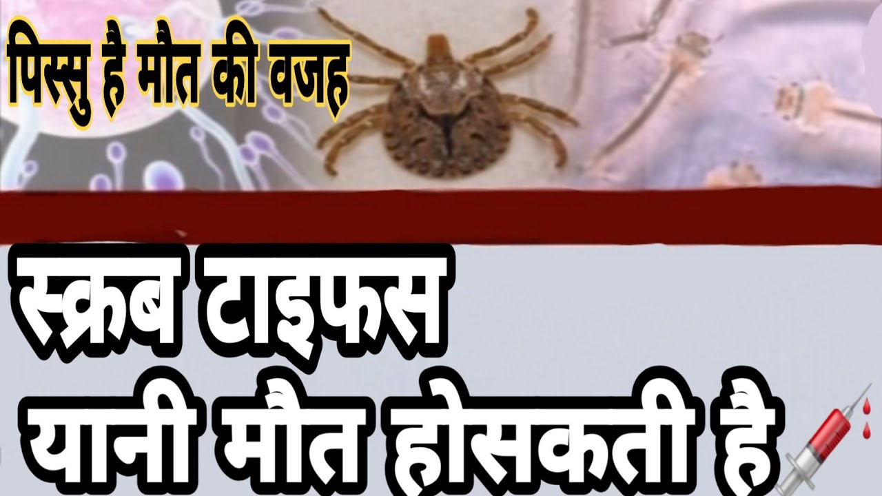 इस पिस्सु के काटने से होसकती है मौत#scrub typhus#