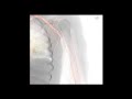 Mentice Transradial Approach Product Video