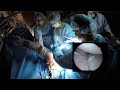 Arthroscopic Shoulder Dislocation Surgery