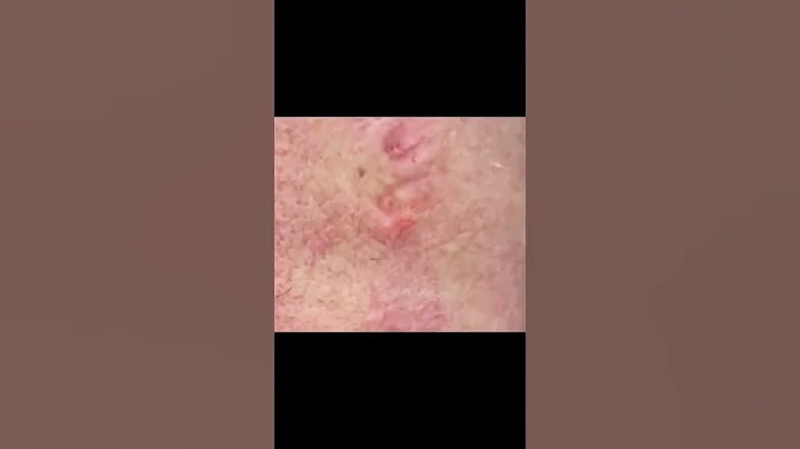 Quick Blackhead Extraction