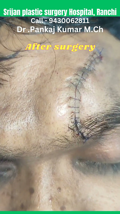 Scar revision surgery of forehead scar #shorts #scartreatment