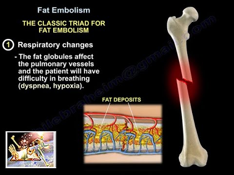 Video: Fat Embolism, Fatty Pulmonary Embolism, Fatty Embolism In Fractures