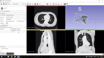 3D slicer segmentation tracheostoma 2