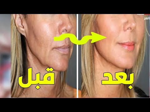 شد الوجه بالليزر أحدث التقنيات والأسعار والمميزات والعيوب مع د/ أنجي  العزازي - YouTube