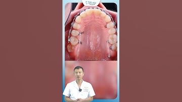 Cận Cảnh Kéo Răng 7,8 Thay Thế Vị Trí Răng 6 Bị Mất Khi Niềng Răng | Bác Sĩ Yên