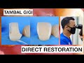 Step by Step Direct Veneer Composite Restoration | Dentist Griya RR