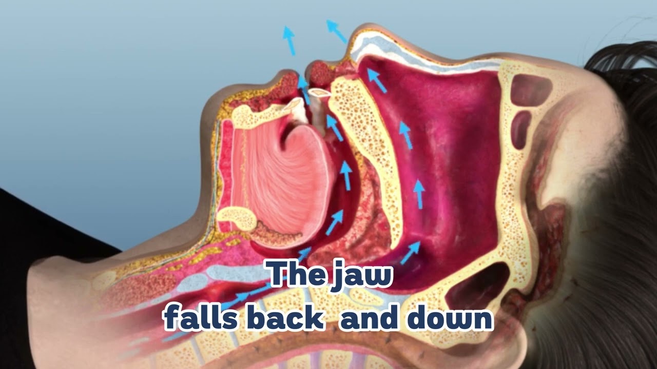 Visual Explanation of Oral Devices