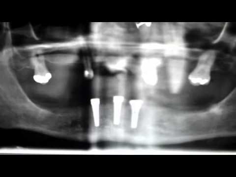 Video: Biologische Implantaten Lossen Op In Het Lichaam - Alternatieve Mening