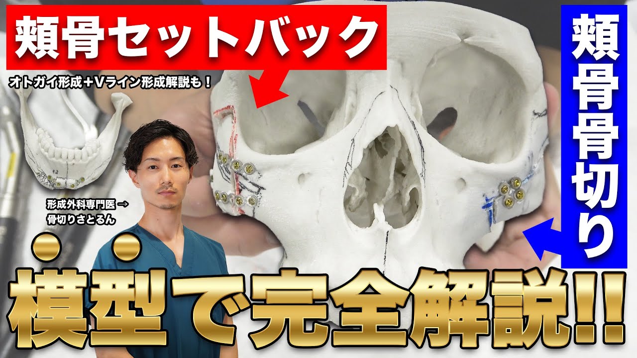 【小顔】模型で手術を完全解説!頬骨骨切りってどんな手術?【骨切りさとるん】