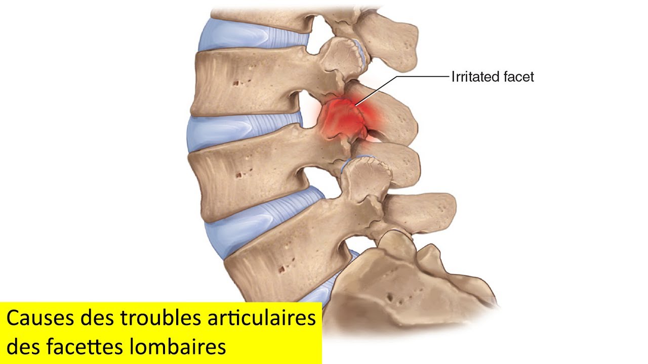 Causes Des Troubles Articulaires Des Facettes Lombaires YouTube causes-des-troubles-articulaires-des-facettes-lombaires-youtube