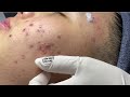 Acne treatment for spa linh mun 2024 88