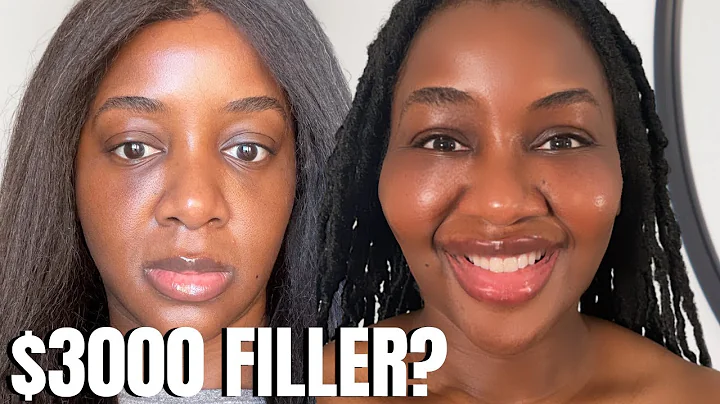 VLOG: Cheek Filler BEFORE and AFTER (Black Skin)