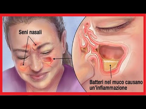 Video: 3 moduri de a ameliora durerile de cap datorate nasului aglomerat