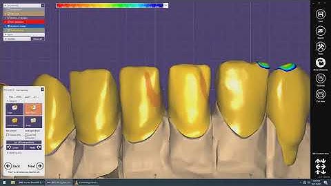 Exocad Attachment telescopic crown design with cutback