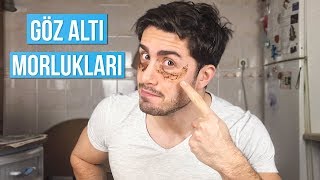 Göz Altı Morluk / Şişliklerine ELVEDA :)