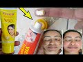 ViccoTurmeric cream|Remove Acne|Pimples|Pigmentation Dark Spots  From Face|complete Reviewहिन्दी मैं
