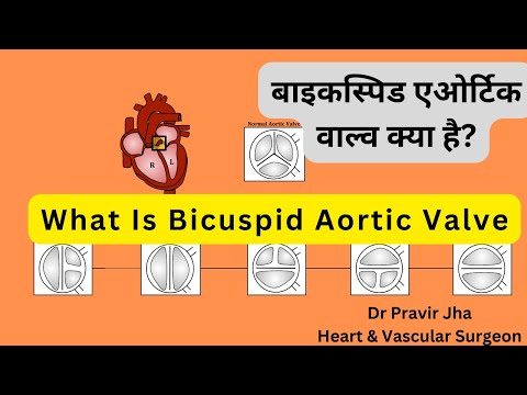 वीडियो: क्या बाइसीपिड एओर्टिक वॉल्व एक बीमारी है?