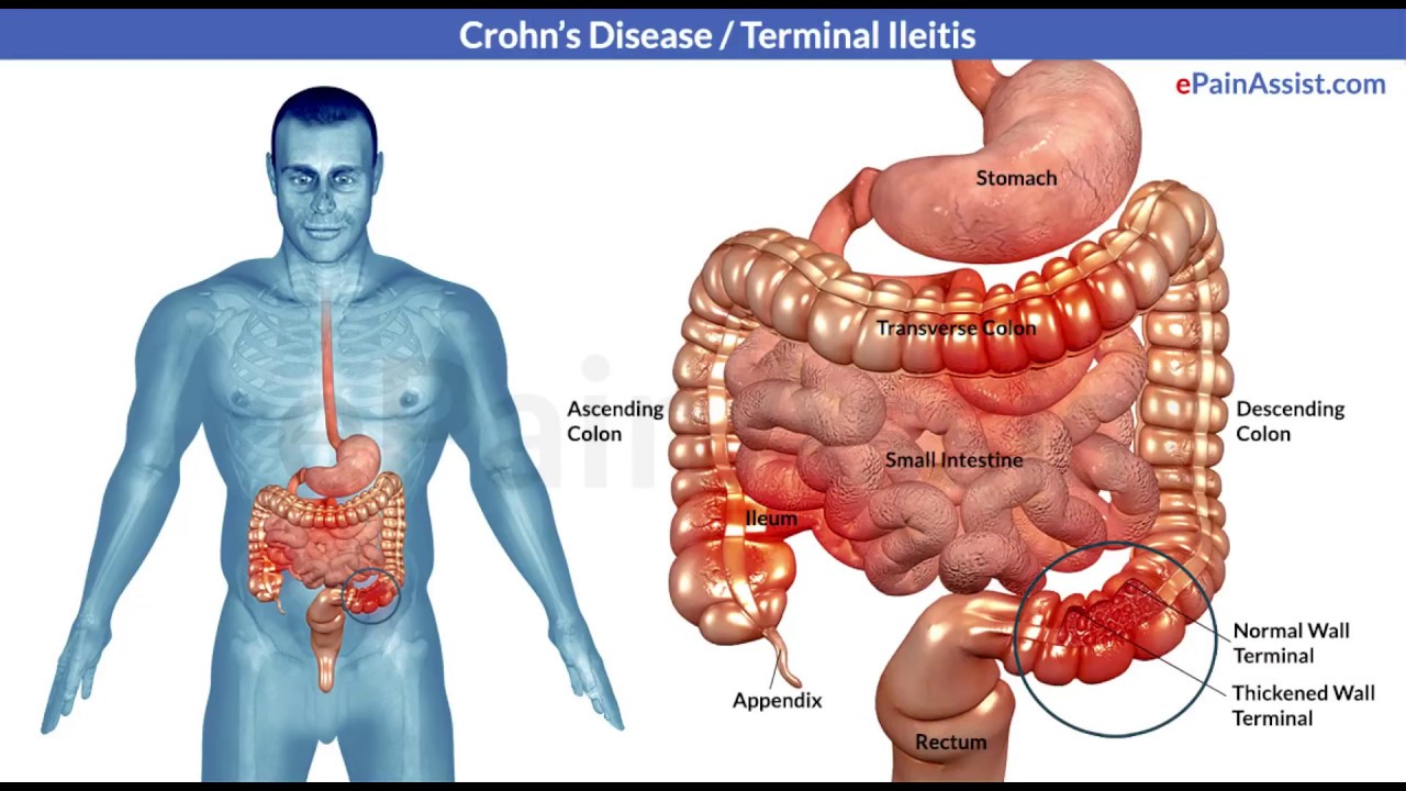 Заболевания кишечника у мужчин. Кишечные проявления болезни крона. Болезнь крона картинки.