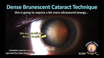 CataractCoach 1239: dense brunescent cataract technique