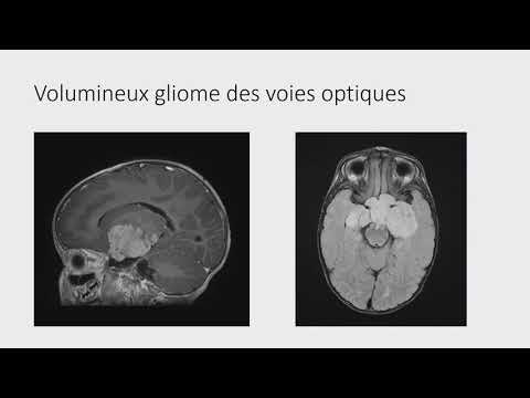 Vidéo: Comment Les Tumeurs Cérébrales Sont-elles Diagnostiquées Et Traitées Chez Les Animaux De Compagnie ?
