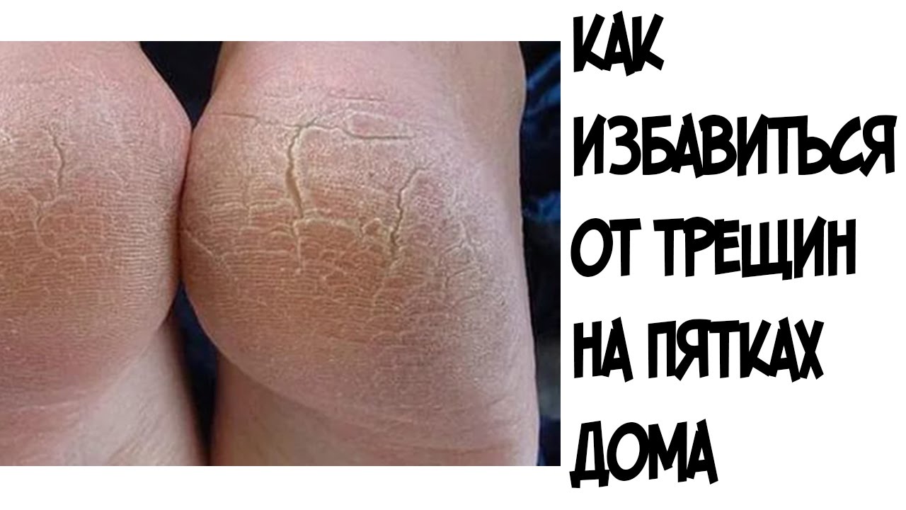 Пятки трещины. Простые способы лечения Пятки трещины. Простые способы лечения