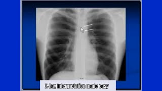 Mediastinum and surrounding structures on chest X-Ray screenshot 5