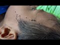 Remove lice from hair step by step - How to get out all hundred lice from his head