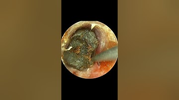 MESMERIZING Deep Earwax Cleaning
