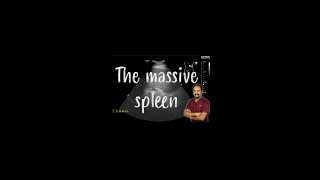 Massive spleen - what do we do?
