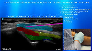 Ultrasound guided tennis elbow cortisone injection by probeultrasound