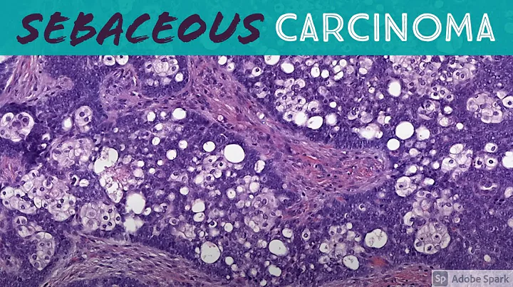 Sebaceous carcinoma (ddx: basal cell carcinoma & b...
