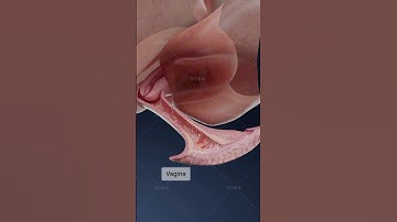 What is herpetic vaginitis and how does it affect the vagina? Explore gynecology in 3D with VOKA