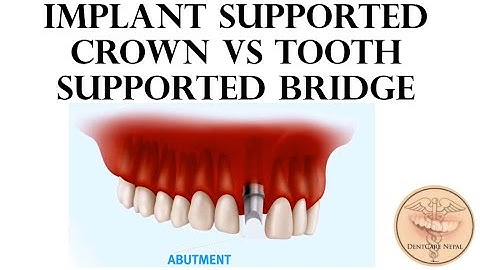 Dental Implant Vs Tooth Supported Fixed Partial Denture